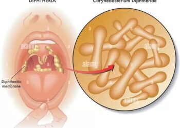 Diphtheria: 4 Children Die, 28 Hospitalized In Kano