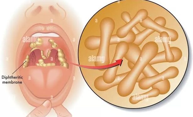 Diphtheria Outbreak