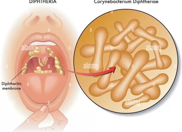 Diphtheria: 4 Children Die, 28 Hospitalized In Kano 1 Diptheria jpeg