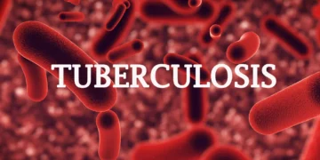 149 Die Of TB, 7,000 Infected In Cross River