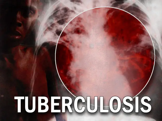 Tuberculosis: Stakeholders Advocate Collective Effort In Addressing Stigmatisation 1 Tuberculosis