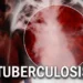 Tuberculosis: Stakeholders Advocate Collective Effort In Addressing Stigmatisation