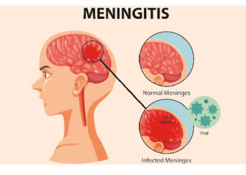 Meningitis: Recurring Epidemic