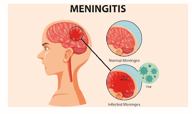 Meningitis Killed 361 In 1 Year – NCDC 1 meningitis