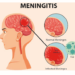 Meningitis Killed 361 In 1 Year – NCDC 5 Meningitis: Recurring Epidemic