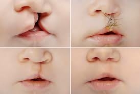 What You Need To Know About Orofacial Cleft 1 Orofacial Cleft