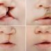 What You Need To Know About Orofacial Cleft