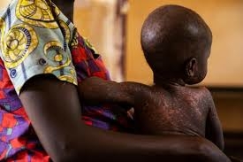 Adamawa Shuts Schools Over Measles Outbreak 1 Measles