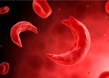 Sickle Cell: Nigerian Surgeon Develops Therapy For Ulcers