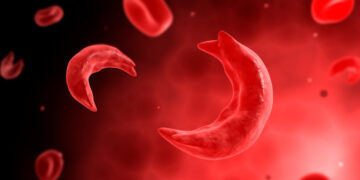 cholera Sickle Cell: Nigerian Surgeon Develops Therapy For Ulcers