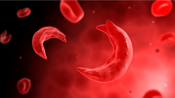 World Sickle Cell Day: Oyo Govt Offers Free Medication 1 Sickle cell