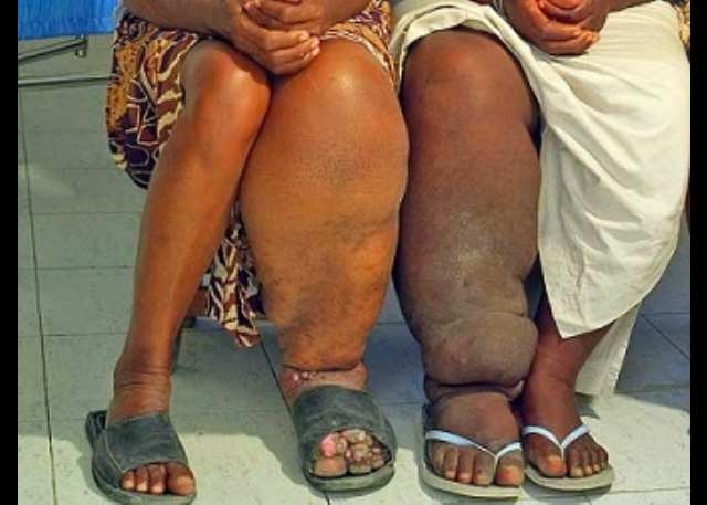 138.9m Nigerians Need Interventions Against Tropical Diseases - WHO 1 NTDs
