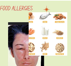 Allergies Are No Joke