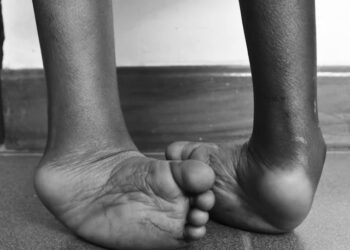 Experts Link Physical Disability To Untreated Clubfoot