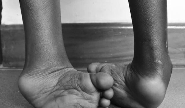 Clubfoot