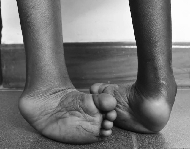 Experts Link Physical Disability To Untreated Clubfoot 1 Untreated Clubfoot