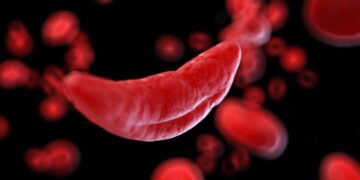 Nigeria’s Sickle Cell Crisis 4 ‘Sickle Cell Disease Not Death Sentence’