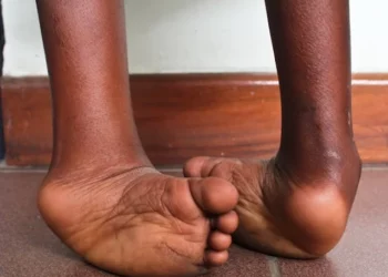 Untreated Clubfoot Among Leading Causes Of Physical Disability Globally