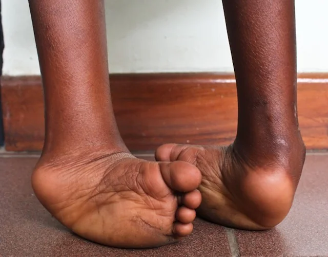 Untreated Clubfoot Among Leading Causes Of Physical Disability Globally 1 wada nieleczona 3