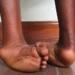 Untreated Clubfoot Among Leading Causes Of Physical Disability Globally 4 Untreated Clubfoot Among Leading Causes Of Physical Disability Globally