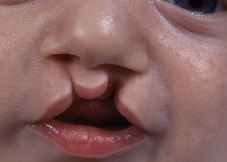 Children With Cleft Lip