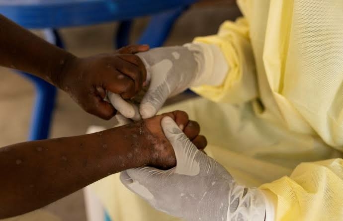 Mpox: Contagious New Variant Found Outside Africa As Sweden Records First Case 1 IMG 7820