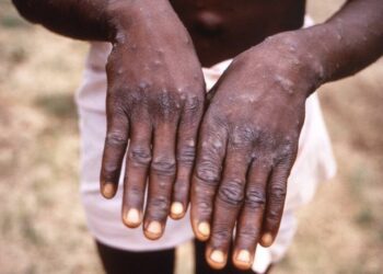 Mpox: ‘Shun Bush Meat Consumption’