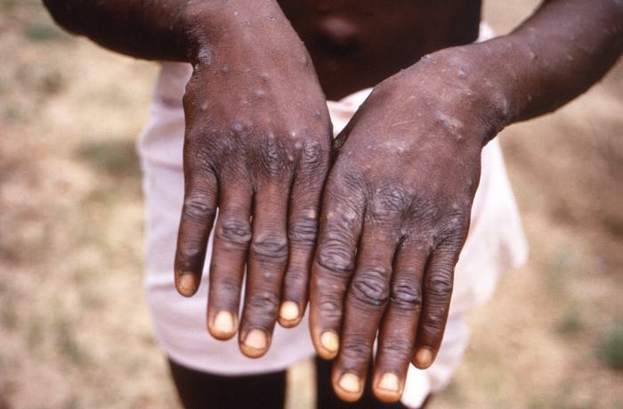 Mpox: ‘Shun Bush Meat Consumption’ 1 Monkeypox1