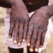 Mpox: ‘Shun Bush Meat Consumption’ 4 Mpox: ‘Shun Bush Meat Consumption’