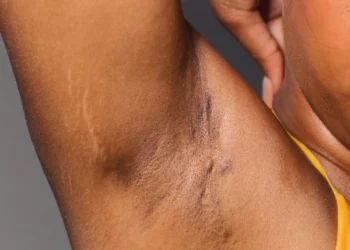 How To Use Baking Soda And Lime To Brighten The Armpits