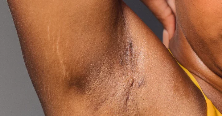 How To Use Baking Soda And Lime To Brighten The Armpits