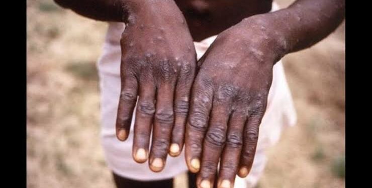 mpox