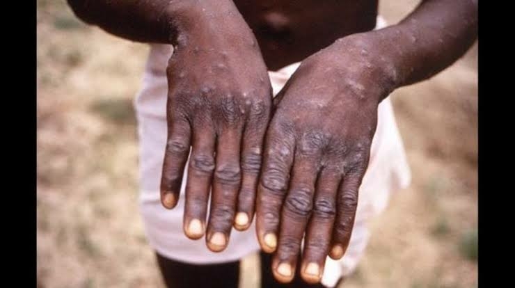 Mpox: WHO Says Nigeria At Moderate Risk As NCDC Confirms 40 Cases 1 mpox