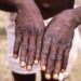 Mpox: WHO Appeals For Funding 5 mpox