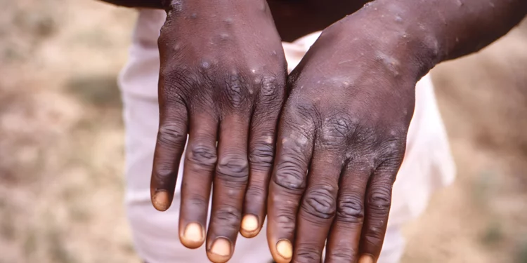 Akwa Ibom Records 5 Mpox Cases