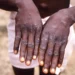 Akwa Ibom Records 5 Mpox Cases 5 Akwa Ibom Records 5 Mpox Cases