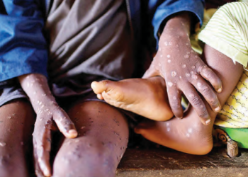 Mpox Resurgence: Implications, Rising Deaths Amidst Nigeria’s Strained Healthcare