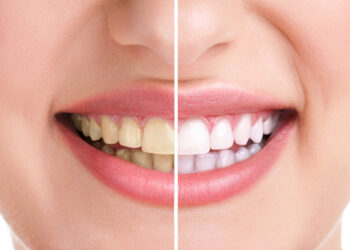 15 Benefits of Professional Teeth Whitening