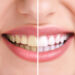 15 Benefits of Professional Teeth Whitening 5 15 Benefits of Professional Teeth Whitening