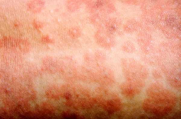 Stay Alert: Measles Outbreaks May Rise This Season 1 BPFRNC 1