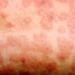 Stay Alert: Measles Outbreaks May Rise This Season 5 Stay Alert: Measles Outbreaks May Rise This Season