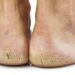 Conquering Harmattan Foot Cracks: Simple Solutions For Smooth Healing 5 Conquering Harmattan Foot Cracks: Simple Solutions For Smooth Healing