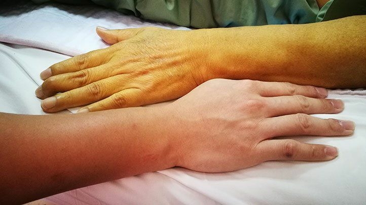 Nigerian Cancer Society To Launch N10bn Intervention Fund 1 Pancreatic Cancer Symptoms
