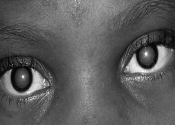 160 People Undergo NNPC’s South West Free Cataract Surgery In Ogun