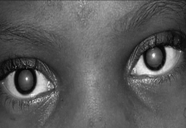 160 People Undergo NNPC's South West Free Cataract Surgery In Ogun 1 Cataract Surgery