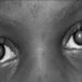 160 People Undergo NNPC’s South West Free Cataract Surgery In Ogun