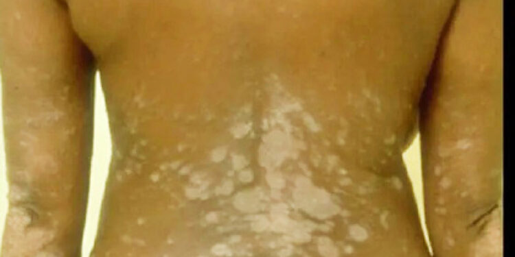 Skin Conditions