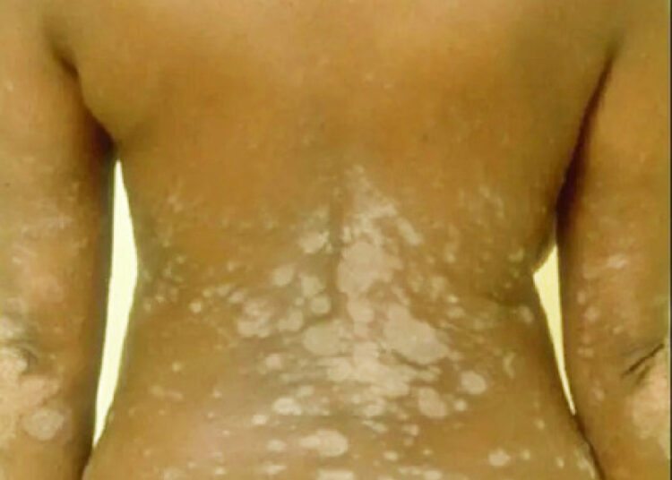 Skin Conditions