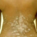 Demystifying Common Skin Conditions, Treatment Options 3 Demystifying Common Skin Conditions, Treatment Options