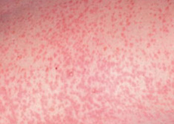 Rubella Virus Vaccine Will Be Introduced In Nigeria Soon – Consultant